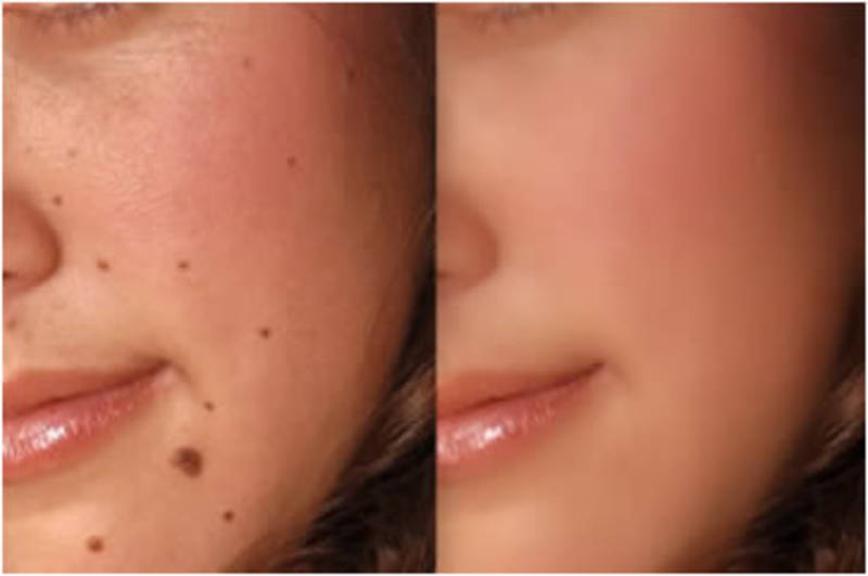 Freckle vs. Mole | Arizona Dermatology